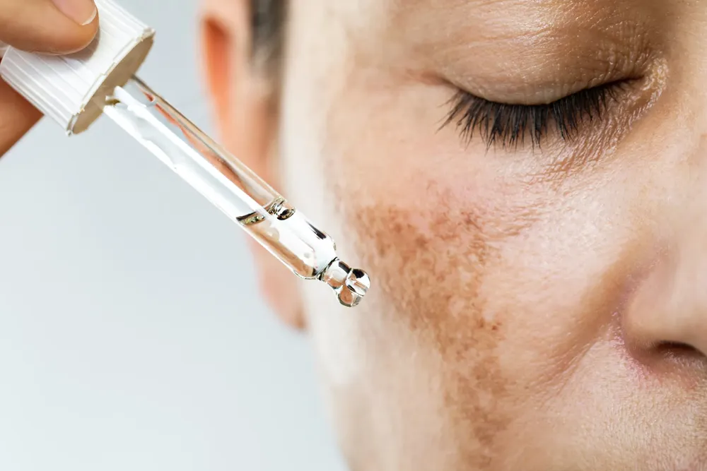 dra-Ubillos-Consejos-para-borrar-el-melasma-portada