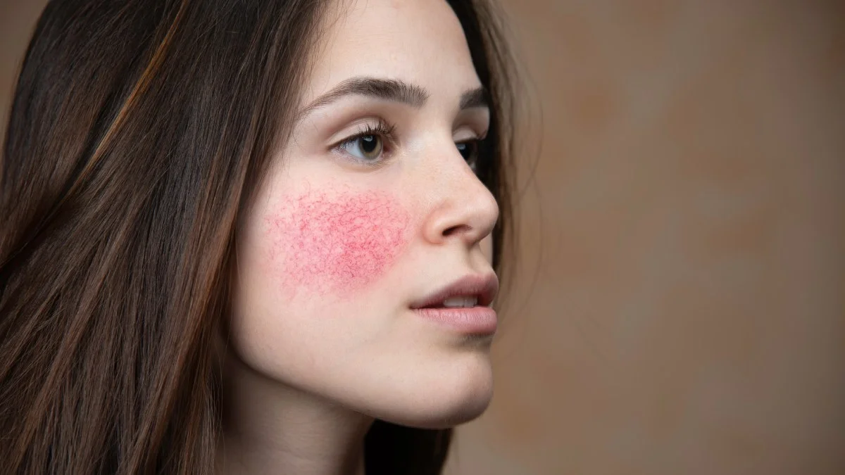 rosacea.jpg